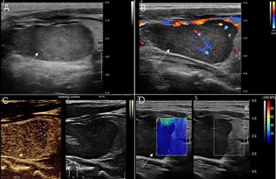 Adult-type rhabdomyoma of the thyroid: A case report
